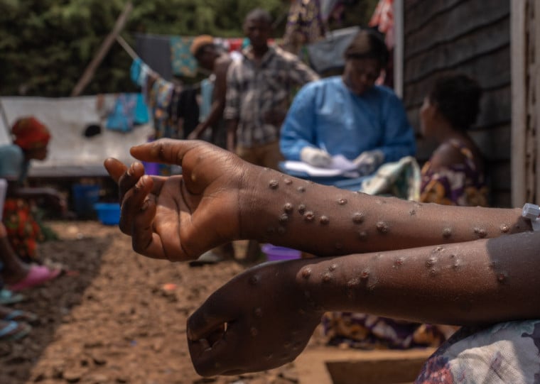 Hospital Kavumu, na República Democrática do Congo, registou mais de 800 casos de mpox